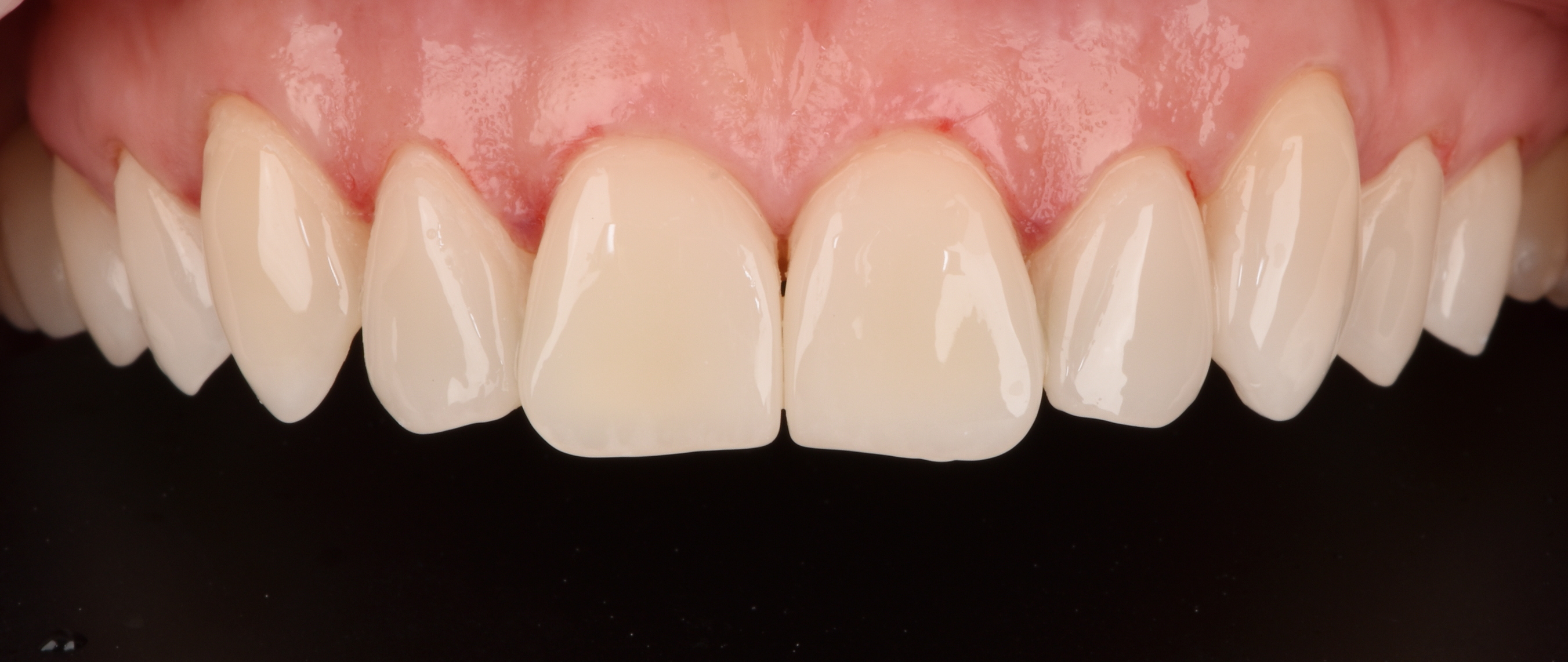 Композитная реставрация 6 зуба. Цифровой дизайн улыбки DSD.